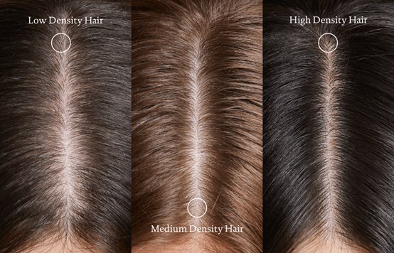 hair density